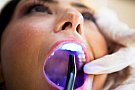 Albire dentara sau fatete dentare?