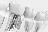 Ce este un implant dentar?