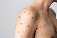 Ce este variola maimuței și care sunt pericolele acesteia