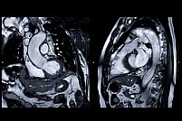 Coronarografia vs. Rezonanta magnetica (RMN): care sunt diferențele?