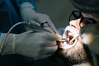  Beneficiile unui implant dentar