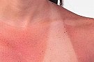 Cum sa tratezi pielea arsa de soare?